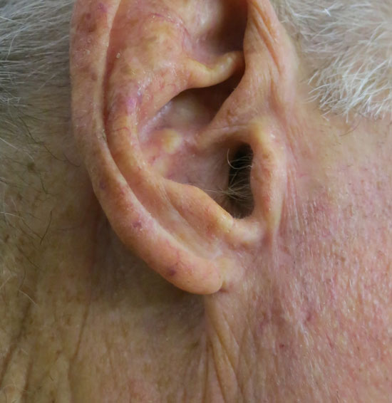 carcinoma-basocellulare-orecchio