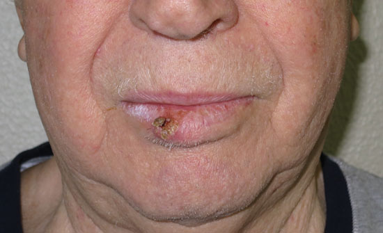 carcinoma spinocellulare labbro inferiore