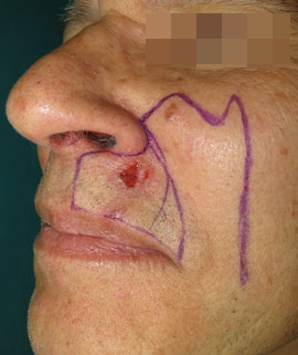 carcinoma spinocellulare labbro superiore